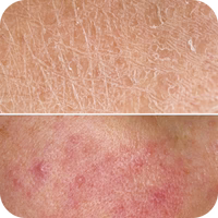 Dry-feeling skin
